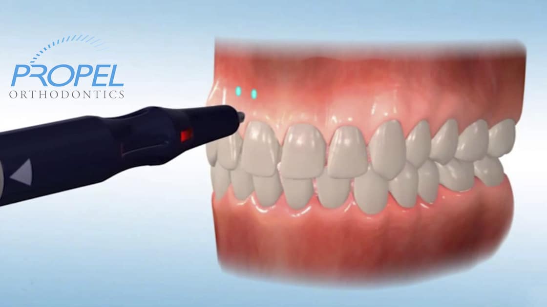 Accelerated treatment photo
