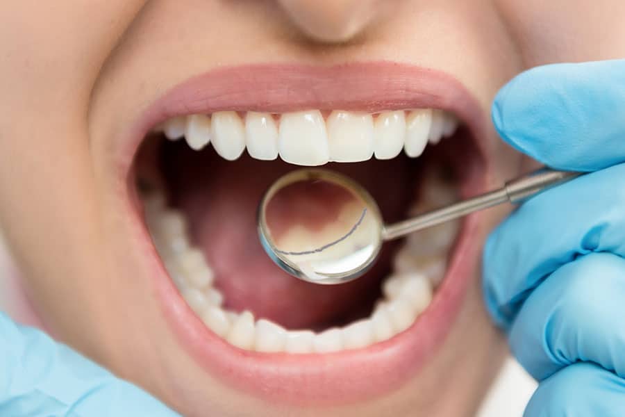 Bonded retainer photo