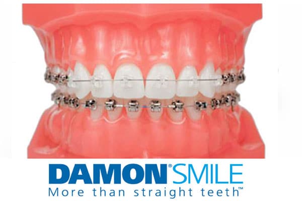 Damon braces photo