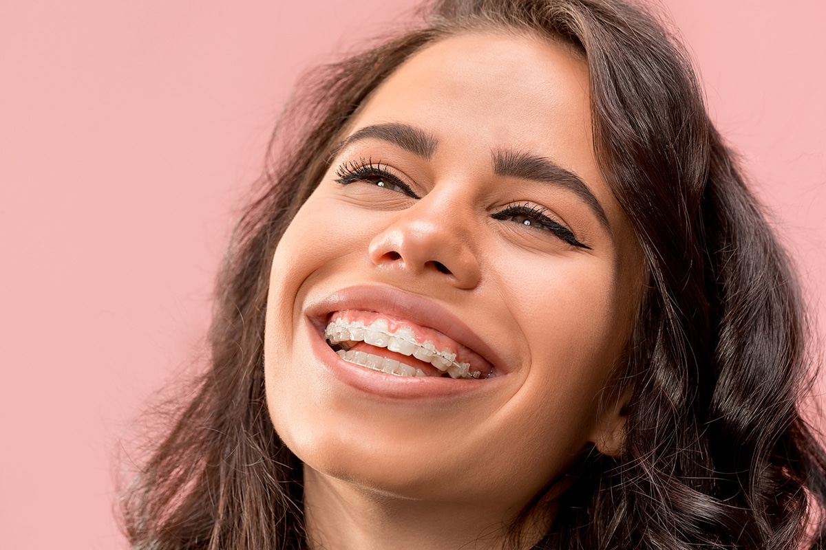 Damon braces vs traditional braces do self ligating brackets move teeth faster blog