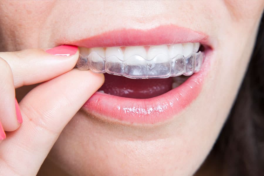Essix retainer photo