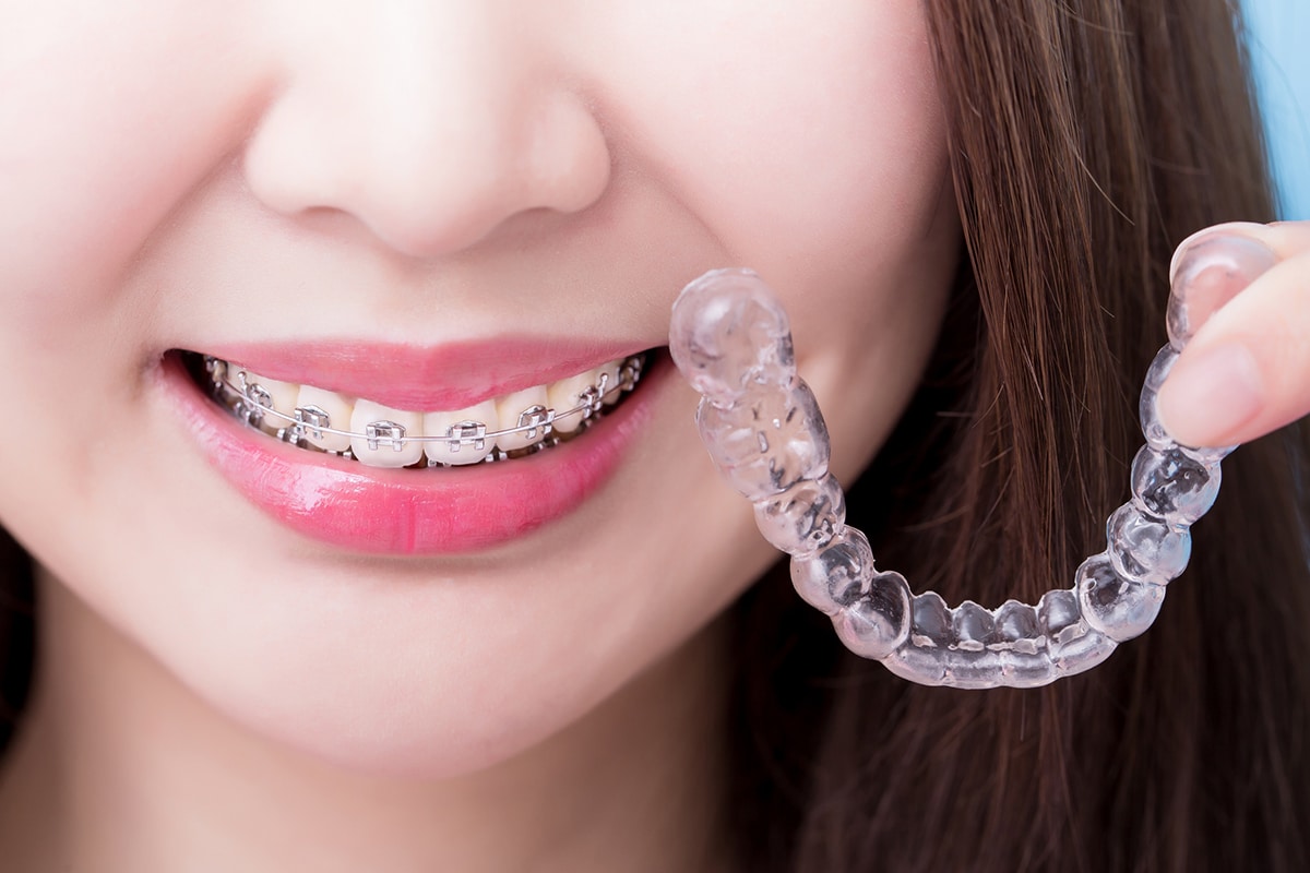 How long does invisalign take timelines by case type blog