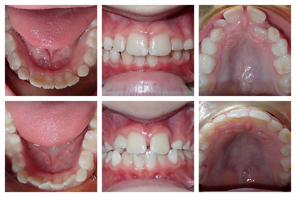 Interceptive orthodontics in cupertino los altos when to start phase 1 treatment for your child blog 2